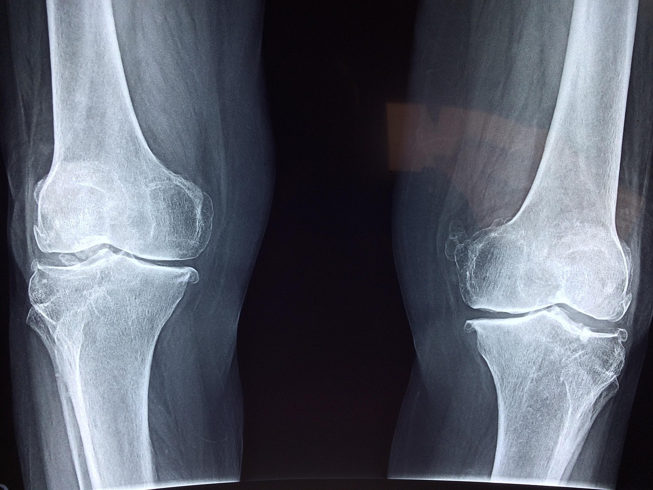 taokinesis-knee-2253047 1280 1