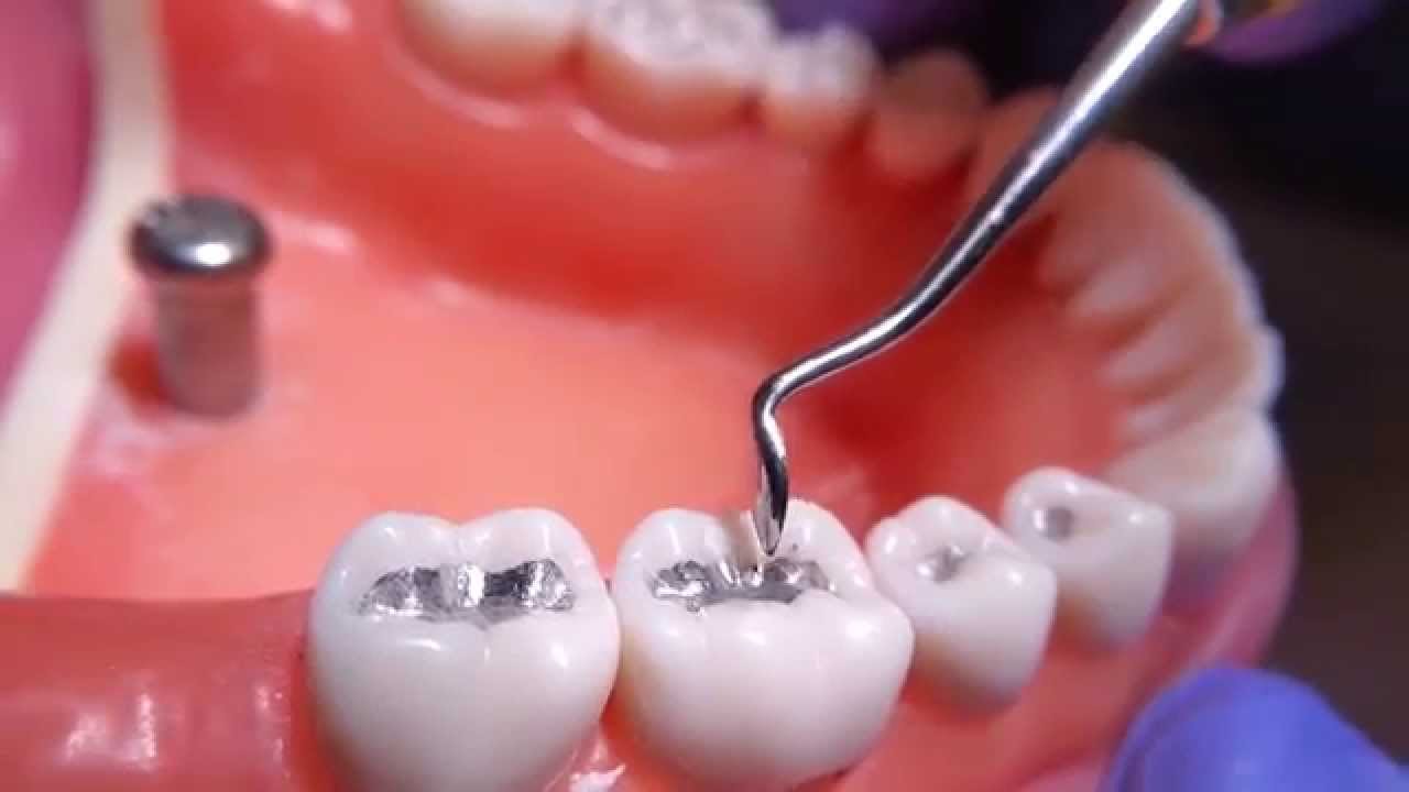 dental amalgum 1